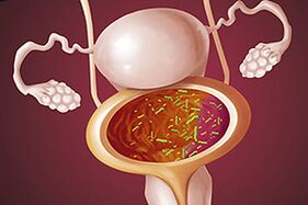 Baktēriju cistīts sievietei